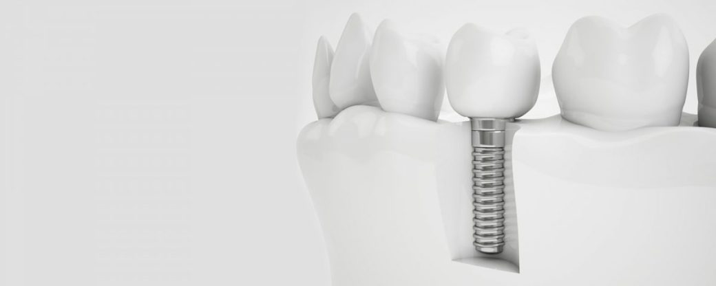 Gebiss oder Implantat