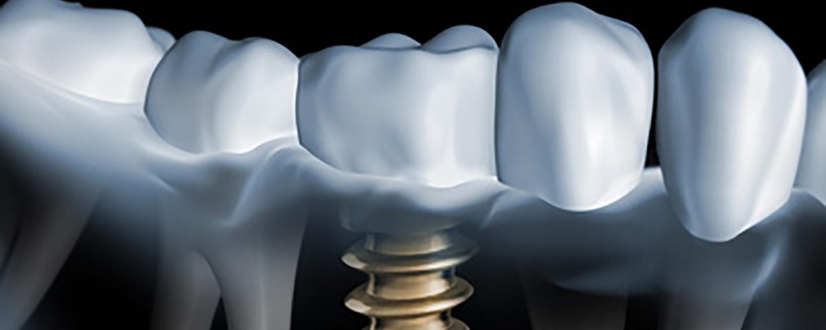 Implantate Titan oder Keramik