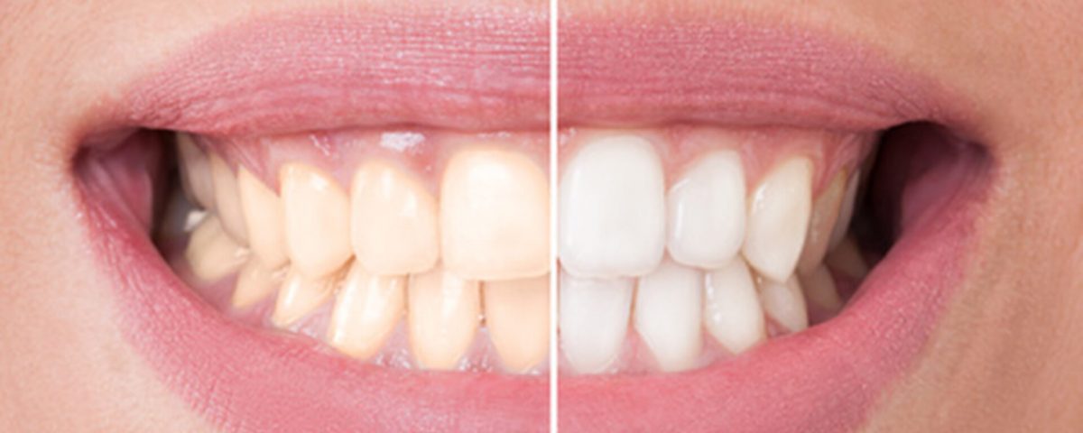 Bleaching Veneers