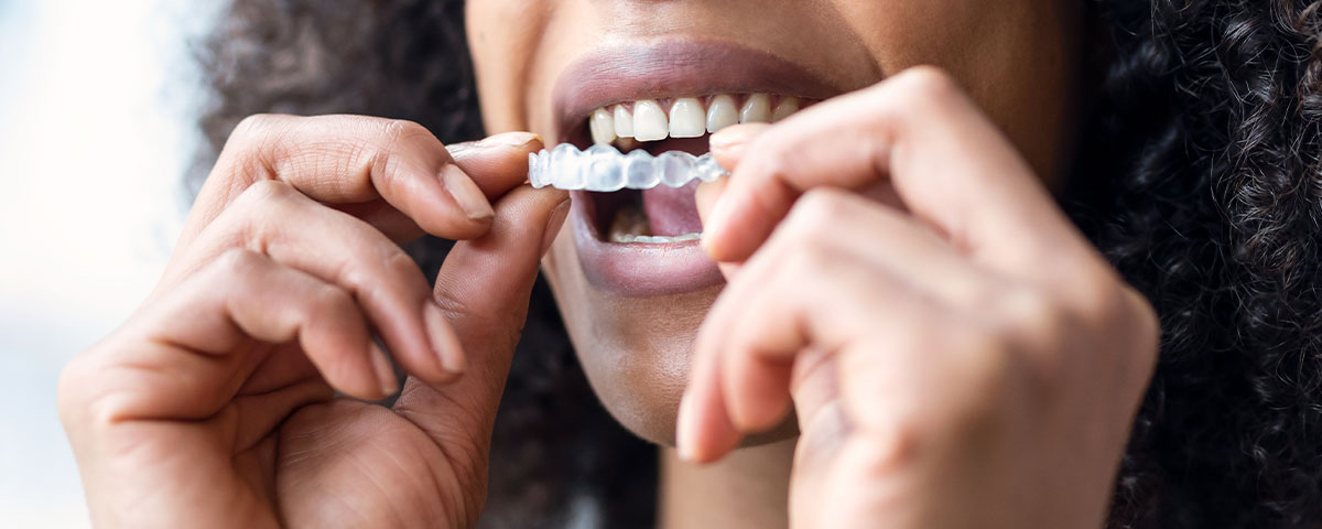 Zahnfehlstellung korrigieren ohne Spange