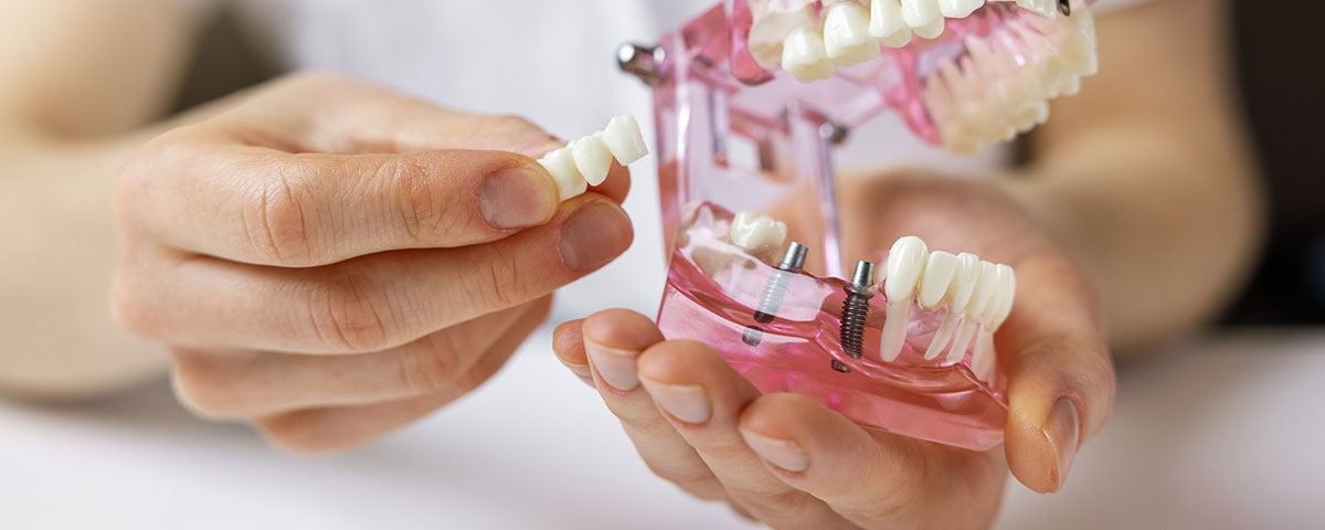 Zahnimplantate aus Titan