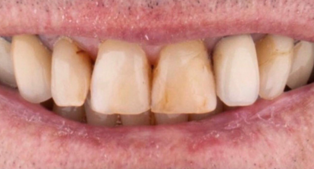 Behandlung Vorher-Nachher-Bild von ZA  Frank Farzin  Falla  MSc. MSc.  | Bonn 0353ab4c Nachher-Bild