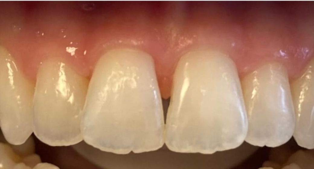 Behandlung Vorher-Nachher-Bild | Bleaching von  Dimitry Giller | Krefeld 218a0aef Nachher-Bild