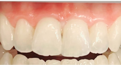 Vorher-Nachher-Bild | Bleaching von  Dimitry Giller | Krefeld 218a0aef Nachher-Bild