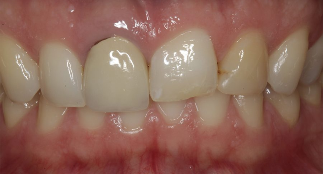 Behandlung Vorher-Nachher-Bild | Veneers von Dr. med. dent. Nikolas Ganß | Köln 49ae49a2 Nachher-Bild