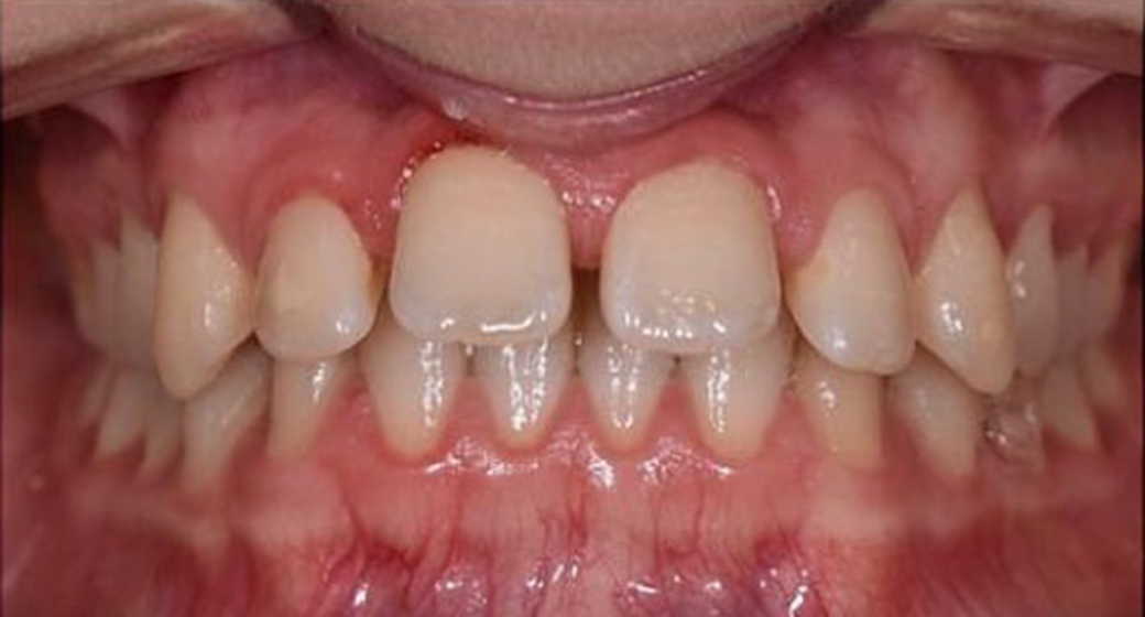 Behandlung Vorher-Nachher-Bild | Aligner  | von Dr. med. dent.  Nassim  Trips  | Rastatt 735b90b4 Nachher-Bild