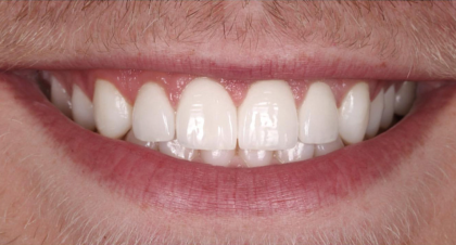 Vorher-Nachher-Bild von    | Hannover  a3f390d8 Nachher-Bild