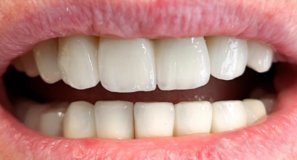 Vorher-Nachher-Bild | Brücken, Kronen  | von Dr. med. dent. Lars Wagenmann | Frechen ab817c93 Nachher-Bild