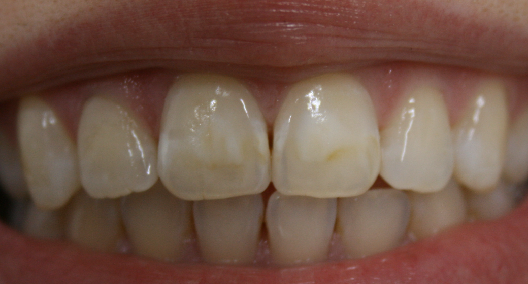 Behandlung Vorher-Nachher-Bild | Bleaching von Dr. med. dent. Kay Zurmühl | Düsseldorf c0c7c76d Nachher-Bild