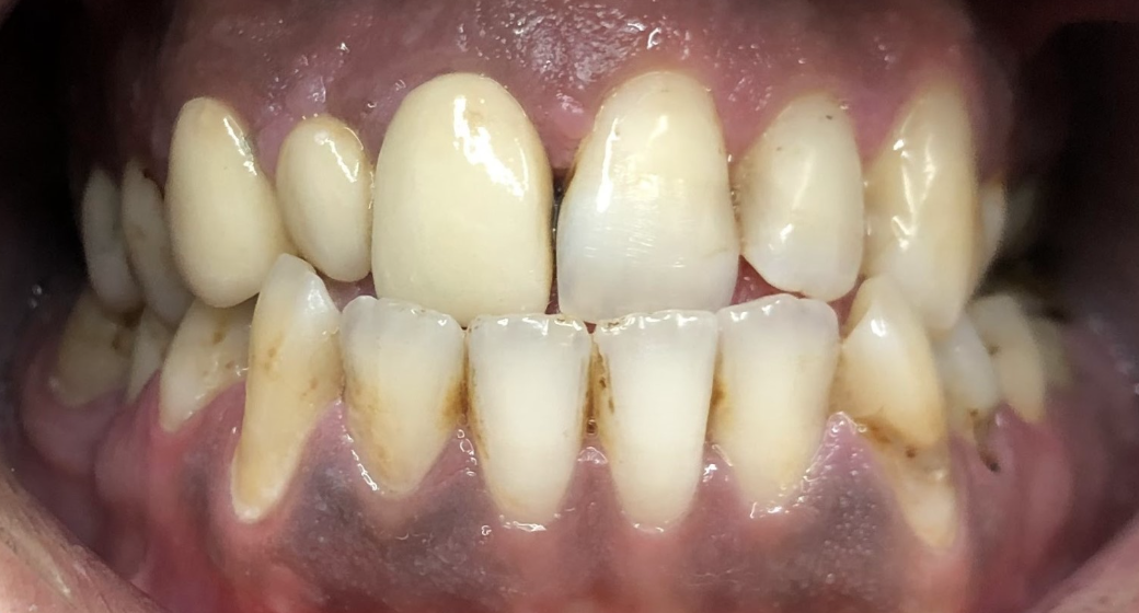 Behandlung Vorher-Nachher-Bild | Bleaching von  Ahmad Saleh | Düsseldorf c0c7c76d Nachher-Bild