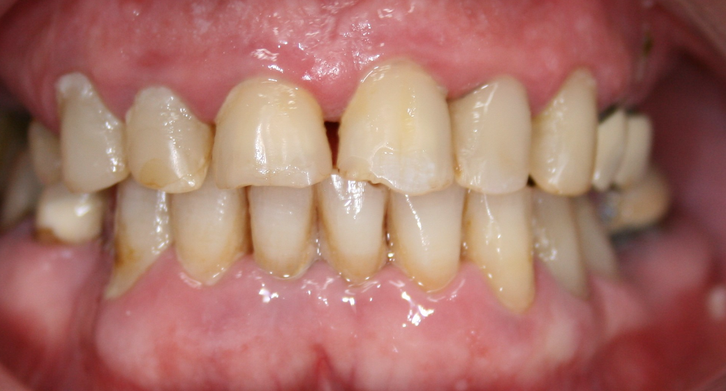 Behandlung Vorher-Nachher-Bild | Brücken von  Ahmad Saleh | Düsseldorf c0c7c76d Nachher-Bild