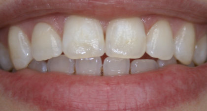 Vorher-Nachher-Bild | Bleaching von Dr. med. dent. Kay Zurmühl | Düsseldorf c0c7c76d Nachher-Bild