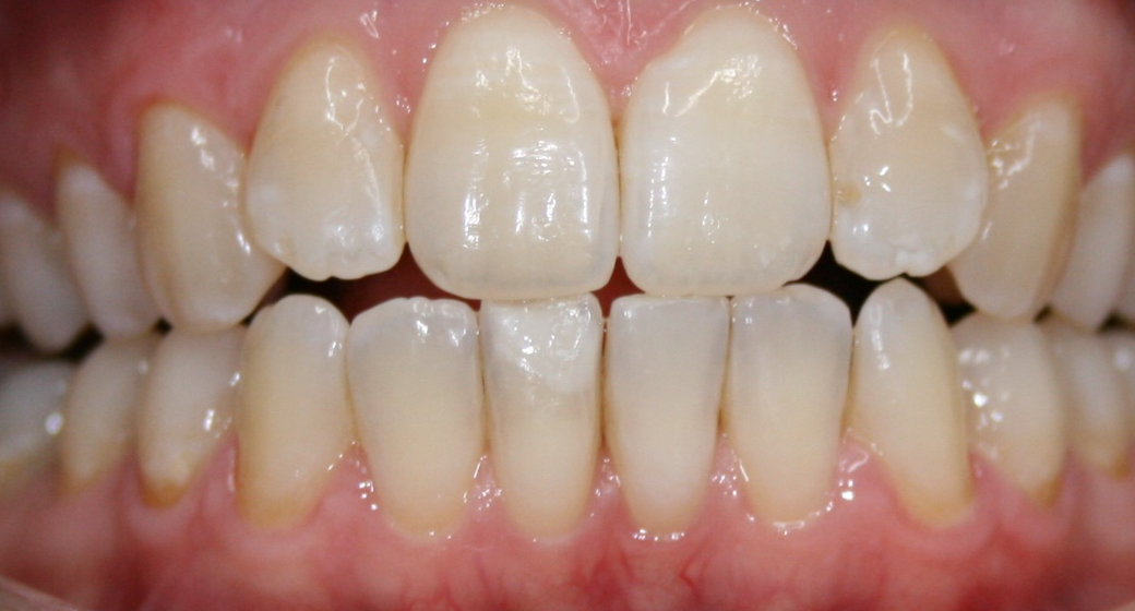 Behandlung Vorher-Nachher-Bild | Prophylaxe von  Ahmad Saleh | Düsseldorf c0c7c76d Nachher-Bild