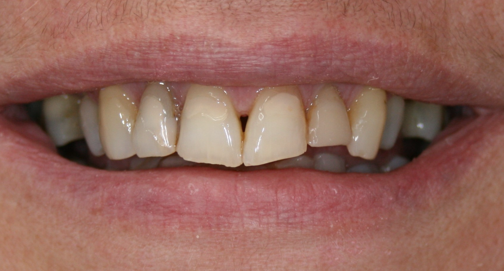 Behandlung Vorher-Nachher-Bild | Kronen von  Ahmad Saleh | Düsseldorf c0c7c76d Nachher-Bild