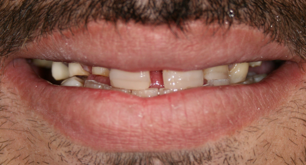 Behandlung Vorher-Nachher-Bild | Brücken von  Ahmad Saleh | Düsseldorf c0c7c76d Nachher-Bild