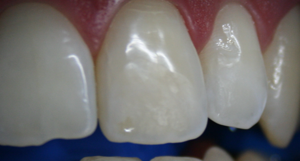 Vorher-Nachher-Bild | Bleaching von Dr. med. dent. Kay Zurmühl | Düsseldorf c0c7c76d Nachher-Bild