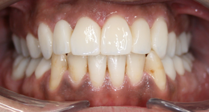 Vorher-Nachher-Bild | Bleaching von  Ahmad Saleh | Düsseldorf c0c7c76d Nachher-Bild