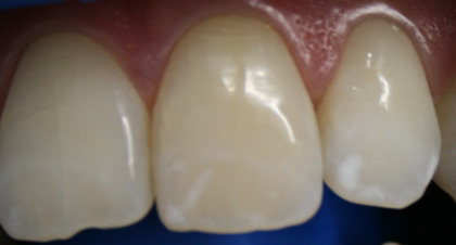 Vorher-Nachher-Bild | Bleaching von Dr. med. dent. Kay Zurmühl | Düsseldorf c0c7c76d Vorher-Bild