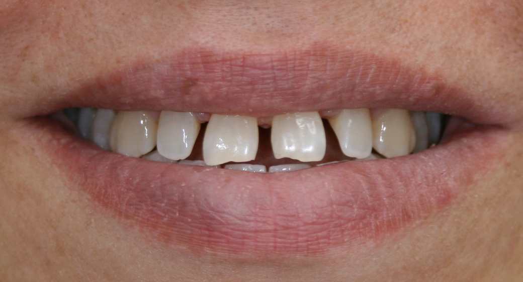 Behandlung Vorher-Nachher-Bild | Bleaching von  Ahmad Saleh | Düsseldorf c0c7c76d Nachher-Bild