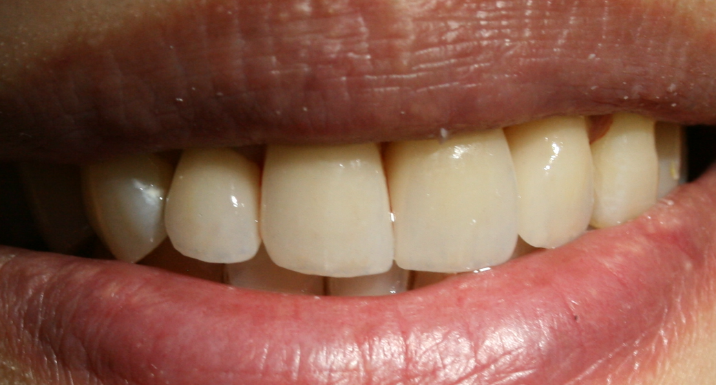 Behandlung Vorher-Nachher-Bild | Brücken von Dr. med. dent. Kay Zurmühl | Düsseldorf c0c7c76d Vorher-Bild