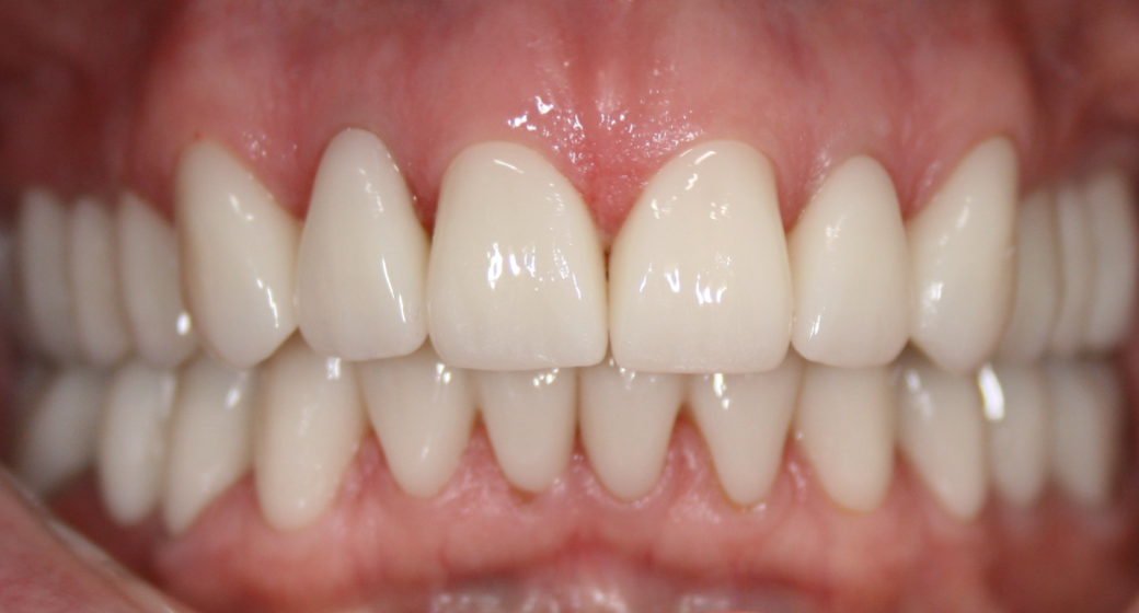 Behandlung Vorher-Nachher-Bild | Bleaching von  Ahmad Saleh | Düsseldorf c0c7c76d Vorher-Bild