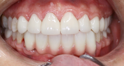 Vorher-Nachher-Bild | Kronen von  Ahmad Saleh | Düsseldorf c0c7c76d Nachher-Bild