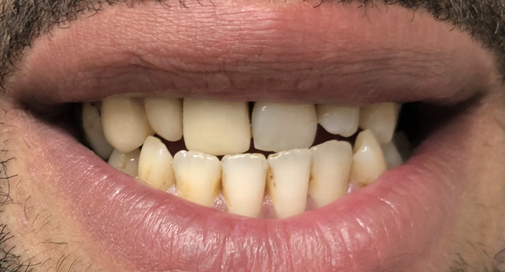 Behandlung Vorher-Nachher-Bild | Bleaching von  Ahmad Saleh | Düsseldorf c0c7c76d Nachher-Bild