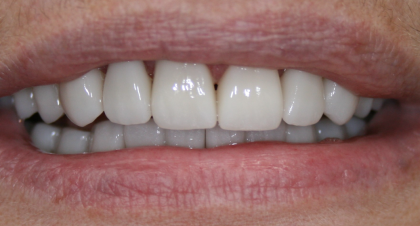 Vorher-Nachher-Bild | Kronen von  Ahmad Saleh | Düsseldorf c0c7c76d Nachher-Bild