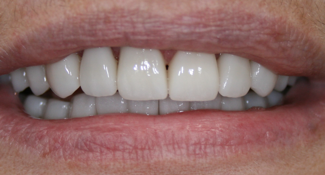 Behandlung Vorher-Nachher-Bild | Kronen von  Ahmad Saleh | Düsseldorf c0c7c76d Vorher-Bild