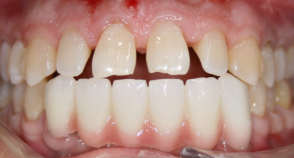 Vorher-Nachher-Bild | Kronen von  Ahmad Saleh | Düsseldorf c0c7c76d Vorher-Bild