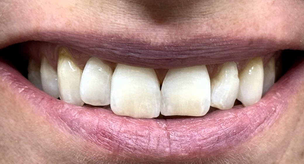 Behandlung Vorher-Nachher-Bild | Prophylaxe von  Ahmad Saleh | Düsseldorf c0c7c76d Vorher-Bild