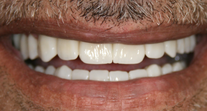 Vorher-Nachher-Bild | Bleaching von  Ahmad Saleh | Düsseldorf c0c7c76d Nachher-Bild