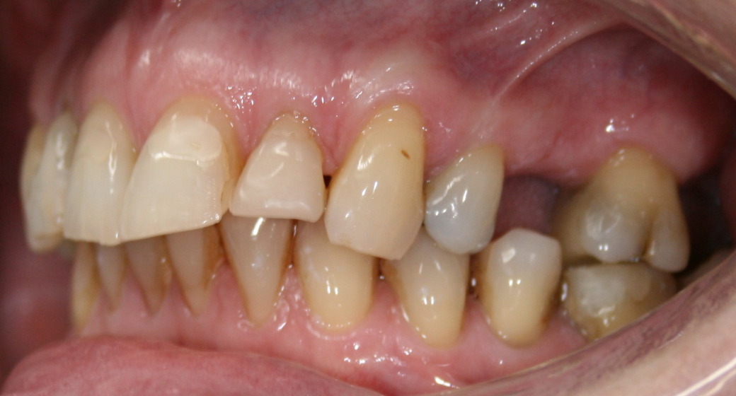 Behandlung Vorher-Nachher-Bild | Brücken von  Ahmad Saleh | Düsseldorf c0c7c76d Nachher-Bild