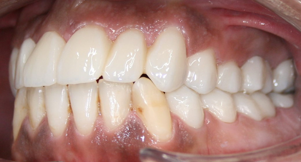 Behandlung Vorher-Nachher-Bild | Bleaching von  Ahmad Saleh | Düsseldorf c0c7c76d Vorher-Bild