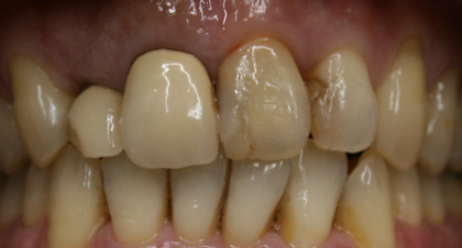 Vorher-Nachher-Bild | Brücken von Dr. med. dent. Kay Zurmühl | Düsseldorf c0c7c76d Vorher-Bild