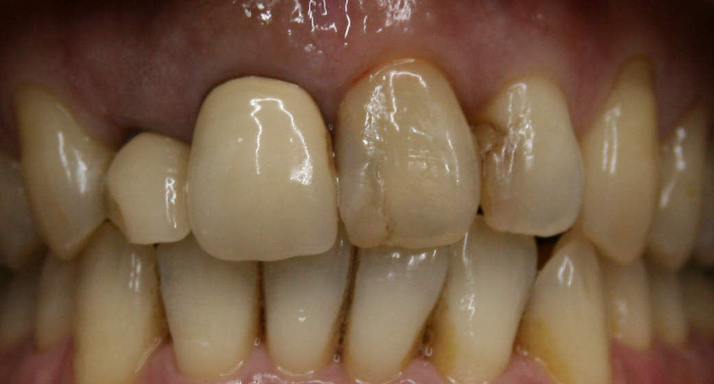 Behandlung Vorher-Nachher-Bild | Brücken von Dr. med. dent. Kay Zurmühl | Düsseldorf c0c7c76d Nachher-Bild