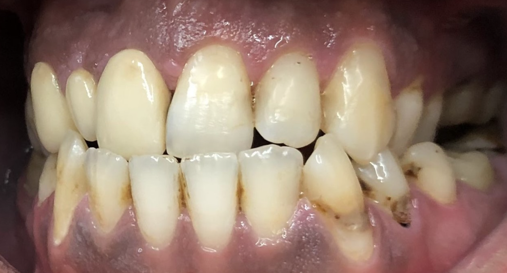 Behandlung Vorher-Nachher-Bild | Bleaching von  Ahmad Saleh | Düsseldorf c0c7c76d Nachher-Bild