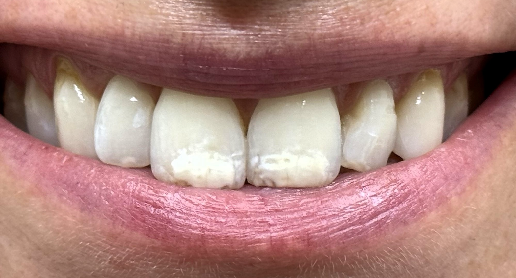 Behandlung Vorher-Nachher-Bild | Prophylaxe von  Ahmad Saleh | Düsseldorf c0c7c76d Nachher-Bild