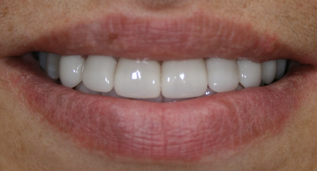 Behandlung Vorher-Nachher-Bild | Bleaching von  Ahmad Saleh | Düsseldorf c0c7c76d Vorher-Bild