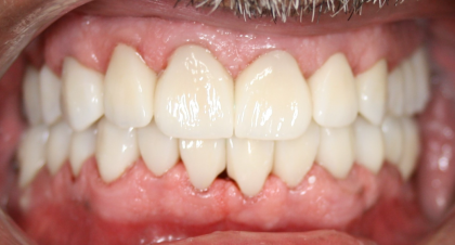 Vorher-Nachher-Bild | Kieferorthopädie von  Ahmad Saleh | Düsseldorf c0c7c76d Nachher-Bild