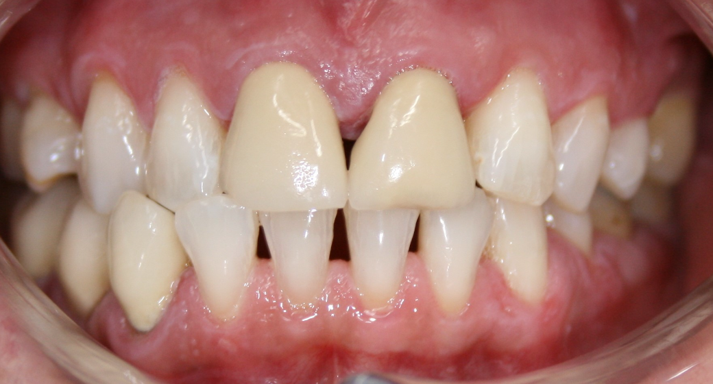 Behandlung Vorher-Nachher-Bild | Veneers von  Ahmad Saleh | Düsseldorf c0c7c76d Nachher-Bild