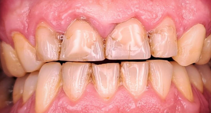 Vorher-Nachher-Bild | Brücken von Zahnärztin Tina Donnerstag | Neckarbischofsheim c7635bfd Vorher-Bild