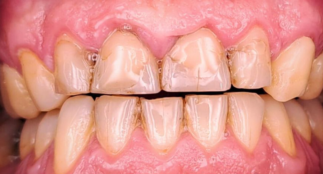 Behandlung Vorher-Nachher-Bild | Brücken von Zahnärztin Tina Donnerstag | Neckarbischofsheim c7635bfd Nachher-Bild