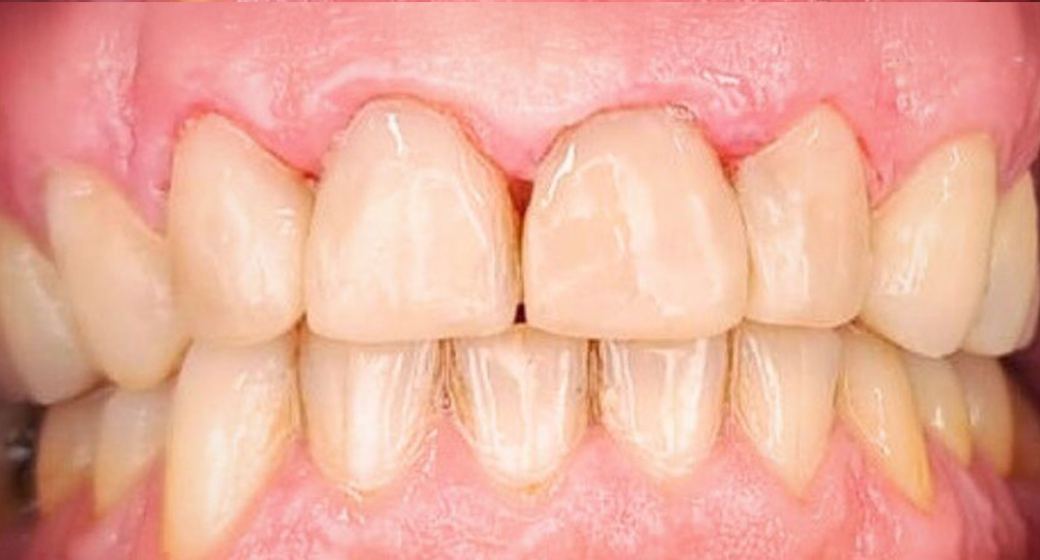 Behandlung Vorher-Nachher-Bild | Brücken von Zahnärztin Tina Donnerstag | Neckarbischofsheim c7635bfd Vorher-Bild