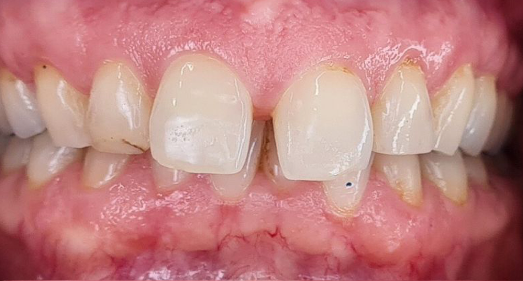 Behandlung Vorher-Nachher-Bild | Aligner von Zahnärztin Tina Donnerstag | Neckarbischofsheim c7635bfd Nachher-Bild