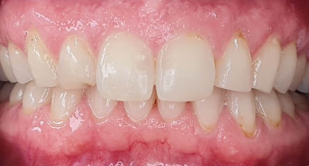 Behandlung Vorher-Nachher-Bild | Aligner von Zahnärztin Tina Donnerstag | Neckarbischofsheim c7635bfd Vorher-Bild