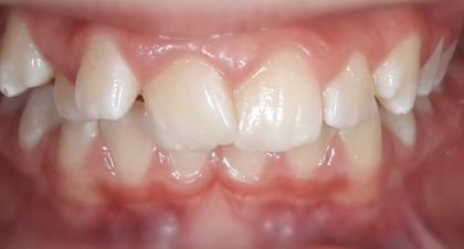 Vorher-Nachher-Bild | Kieferorthopädie von Dr. med. dent. Neda Yavari | Elmshorn d82c8d16 Vorher-Bild