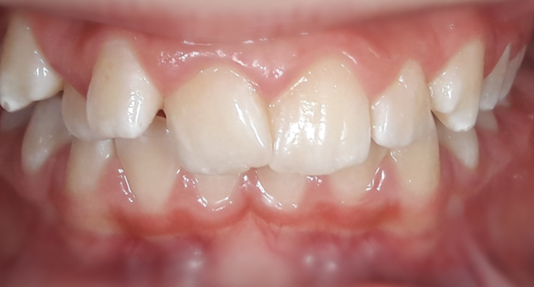 Behandlung Vorher-Nachher-Bild | Kieferorthopädie von Dr. med. dent. Neda Yavari | Elmshorn d82c8d16 Nachher-Bild