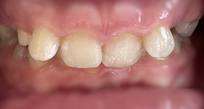 Vorher-Nachher-Bild | Kieferorthopädie von Dr. med. dent. Neda Yavari | Elmshorn d82c8d16 Vorher-Bild