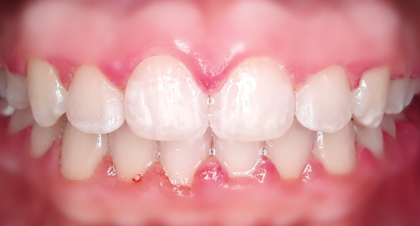 Vorher-Nachher-Bild | Kieferorthopädie von Dr. med. dent. Neda Yavari | Elmshorn d82c8d16 Nachher-Bild